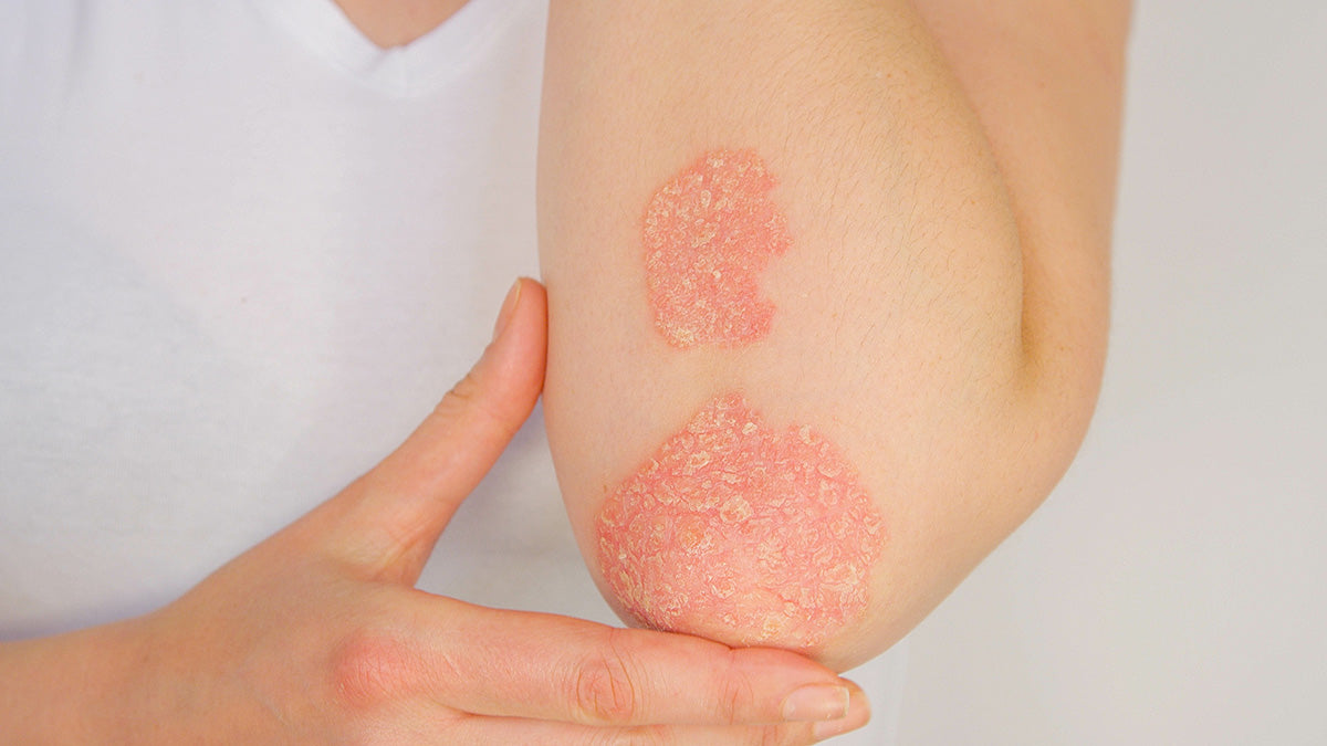 830-nm and 633-nm phototherapy in the treatment of recalcitrant psoriasis